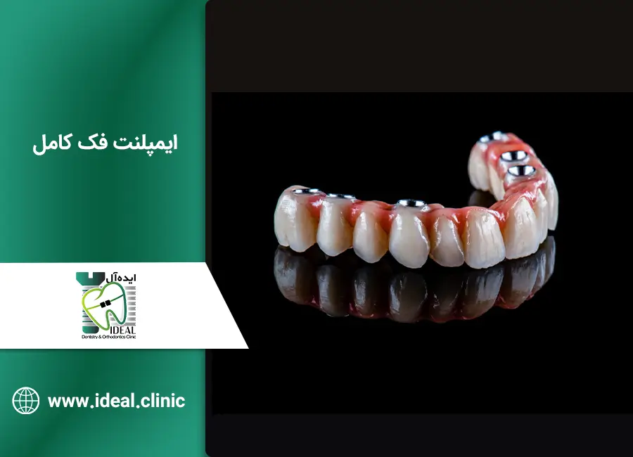 ایمپلنت فک کامل