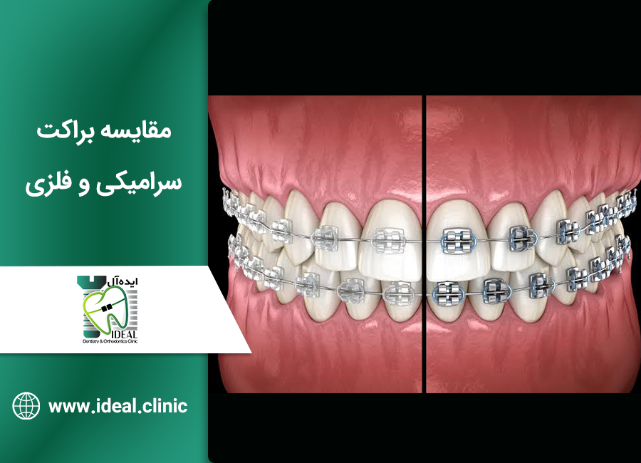 براکت فلزی یا سرامیکی